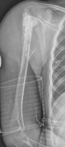 Ortopédi urobili u dvoch pacientov náhradu ramenného kĺbu, ramennej kosti a lakťa