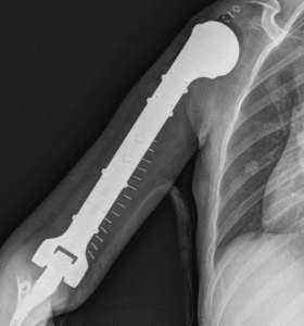 Ortopédi urobili u dvoch pacientov náhradu ramenného kĺbu, ramennej kosti a lakťa